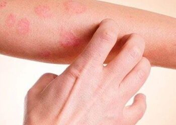 Secretaria de Saúde promove ação durante ‘Janeiro Roxo’ para conscientização sobre hanseníase