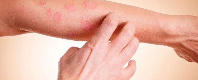 Secretaria de Saúde promove ação durante ‘Janeiro Roxo’ para conscientização sobre hanseníase