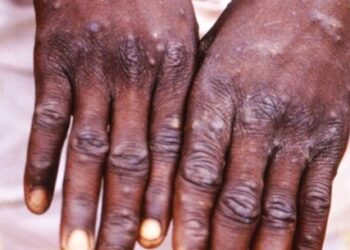 Caraguatatuba registra primeiro caso da varíola dos macacos