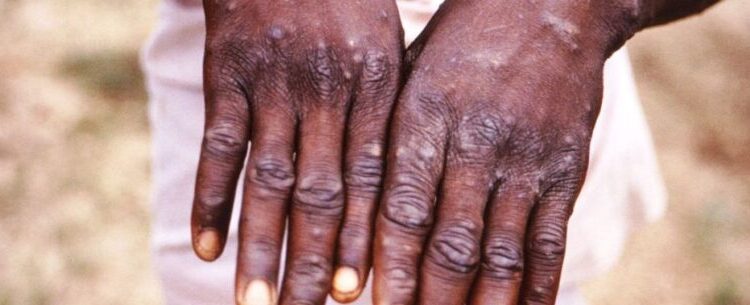 Caraguatatuba registra primeiro caso da varíola dos macacos