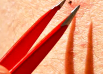 Secretaria de Saúde de Caraguatatuba alerta para cuidados com a Febre Maculosa