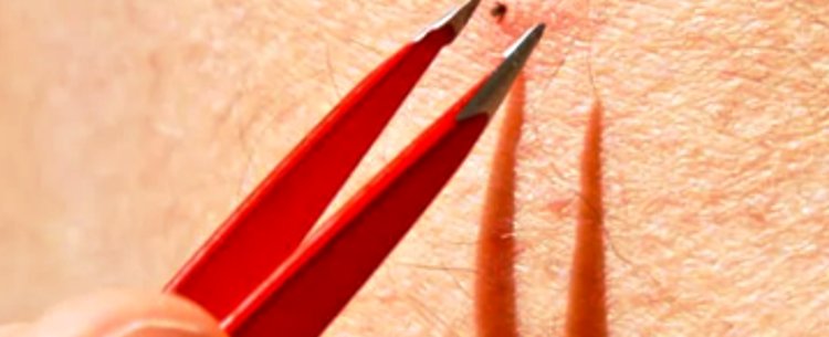 Secretaria de Saúde de Caraguatatuba alerta para cuidados com a Febre Maculosa