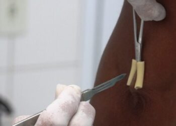 Janeiro Roxo: Secretaria de Saúde de Caraguatatuba promove ações de combate e prevenção a Hanseníase