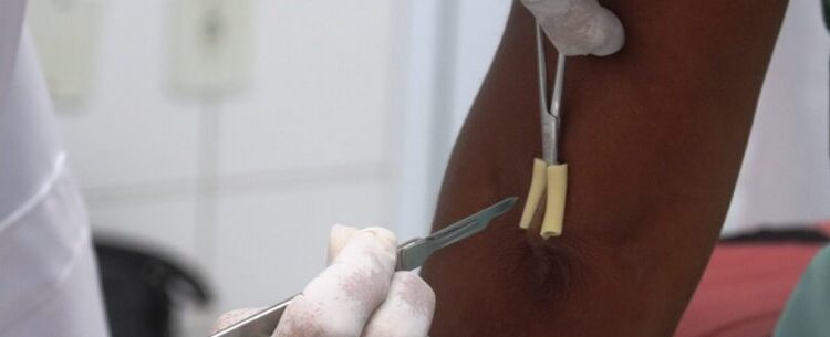 Janeiro Roxo: Secretaria de Saúde de Caraguatatuba promove ações de combate e prevenção a Hanseníase