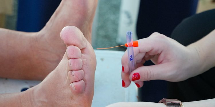 Prefeitura de Bertioga realizada campanha de Prevenção de Riscos do Pé Diabético em Boraceia