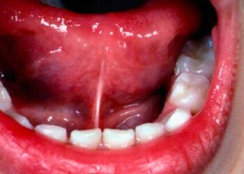 Cirurgia de frenectomia chega à UBS Tinga a partir da próxima semana