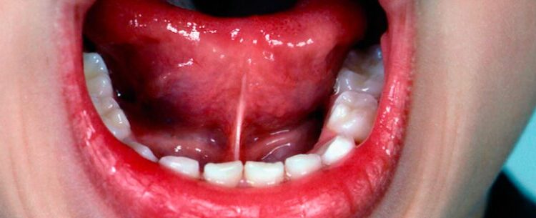 Cirurgia de frenectomia chega à UBS Tinga a partir da próxima semana